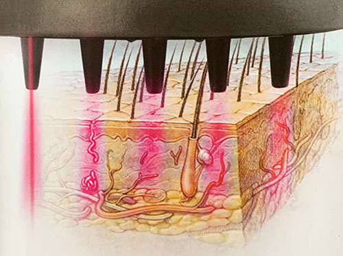 laserundampullenbehandlung 01