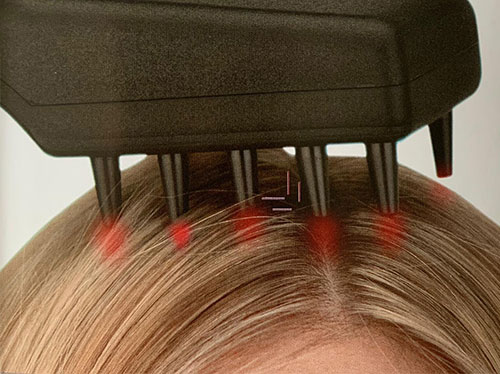 laserundampullenbehandlung 02